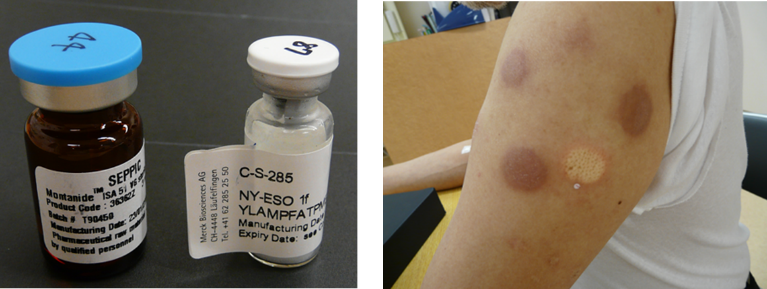 NY-ESO-1ペプチドワクチン