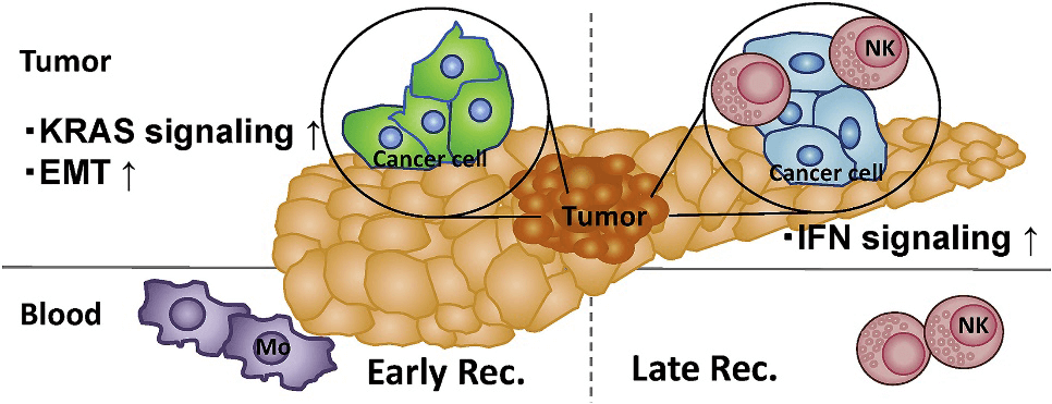 膵がん患者における抗腫瘍免疫応答の評価