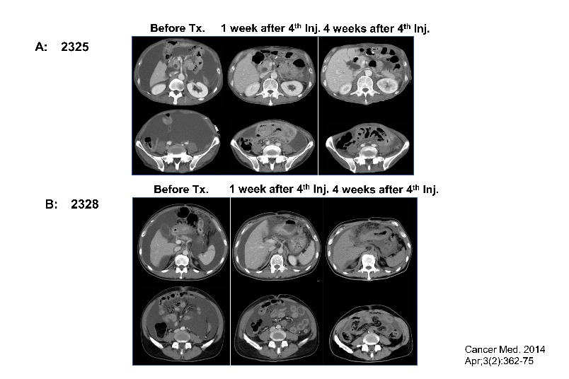 胃癌によるがん性腹膜炎・悪性腹水対するVγ9Vδ2T細胞治療